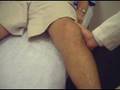 MCL rupture