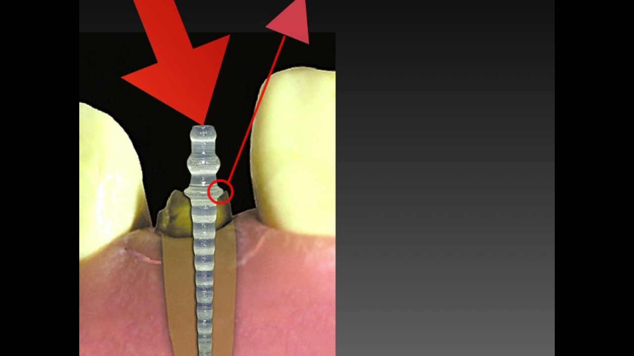 O melhor Pino de Fibra de Vidro é do Brasil