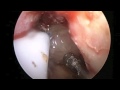 Transnasal Endoscopic Approach to the Pituitary Using an Ultrasonic Aspirator Transnasal Endoscopic Approach to the Pituitary Using an Ultrasonic Aspirator