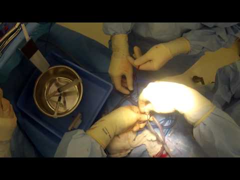 how to collect cord blood