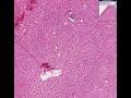 Histopathology Liver--Viral hepatitis