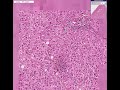 Histopathology Liver--Viral hepatitis
