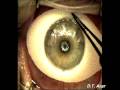Laser-Assisted LASIK
