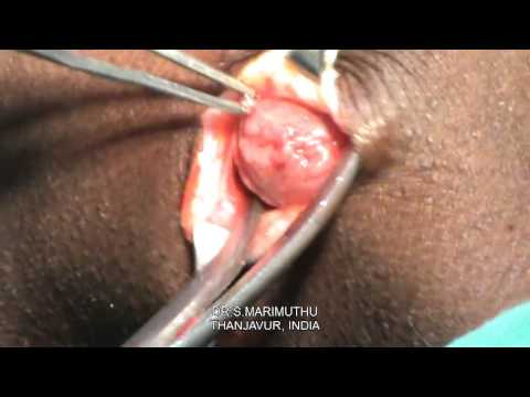 how to perform lymph node biopsy