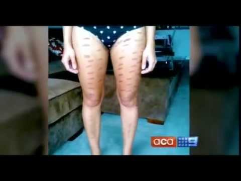 how to treat ipl burns