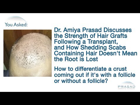 how to wash hair after hair transplant