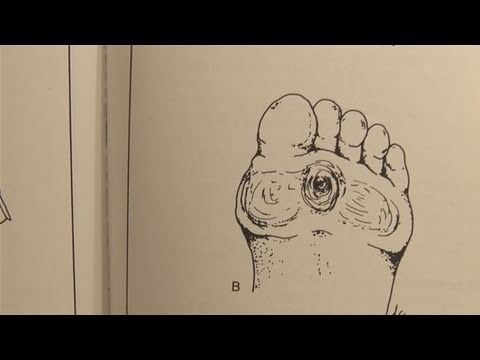 how to get rid or corns