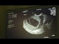 Fraternal Twins Ultrasound at 9 weeks 4 days