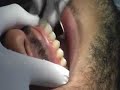Removing Braces Removing Braces