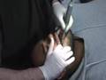 Removing Braces