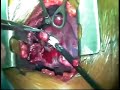 ROMM Procedure/Resection of Multiple Metastases lung cancer ROMM Procedure/Resection of Multiple Metastases lung cancer