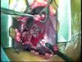 ROMM Procedure/Resection of Multiple Metastases lung cancer