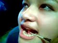 PERFORANDO FRENILLO