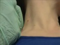 Skin Tag or Mole Removal by Dr. Yuriy Yagudin