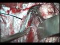 Anterior Transcallosal Approach for Ventricular Tumor