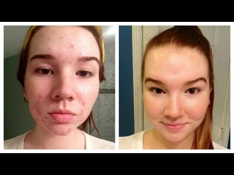 How I Cleared My Acne (+ Before & After Pictures)