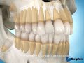 Wisdom Teeth