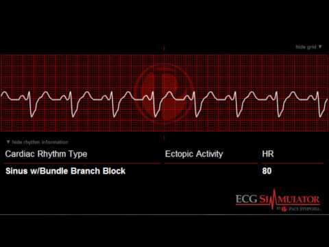 concentric left ventricular hypertrophy icd 9 concentric left ventricular hypertrophy icd 9