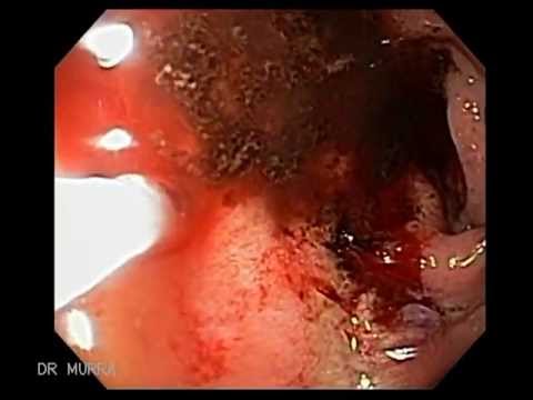 how to treat a stomach ulcer