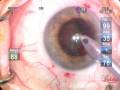 Cataract Extraction (flip-chop technique)