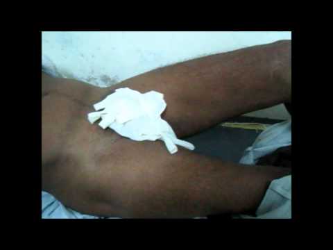how to drain psoas abscess