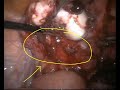 Laparoscopy Annotation