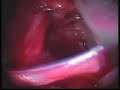 Laparoscopic extraperitoneal hernia repair (optical trocar) Laparoscopic Hernia Repair
