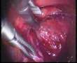 Laparoscopic extraperitoneal hernia repair (optical trocar)