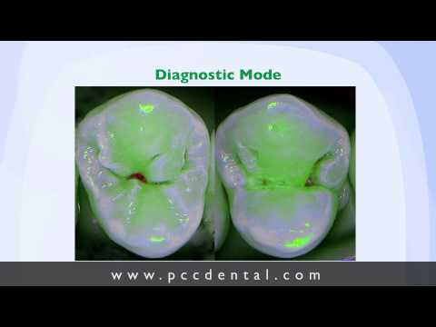 Occlusal Dental Caries Detection See video