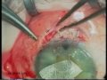 Glaucoma Surgery