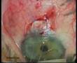 Glaucoma Surgery