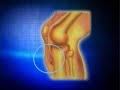 Osgood Shlatters www.footkneepain.com.au
