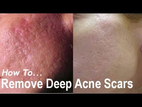 how to repair acne scars