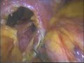 LOTUS - Giant Para-Oesophageal Hernia - Mr Paul Peyser