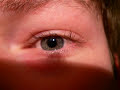Nystagmus - Augenzittern Nystagmus - Augenzittern