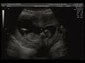 Ecografía Lorenzo 12 semanas Ecografía Lorenzo 12 semanas