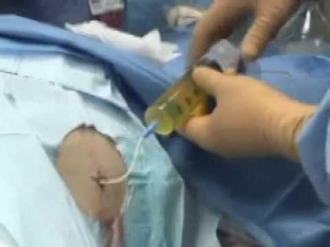 how to perform paracentesis