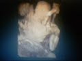 25 week 3D/4D Ultrasound Scan