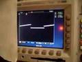 Yamaha CS01 New Hybrid Waveforms Modification