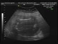 6 meses!!!! Nova ultrassonografia.