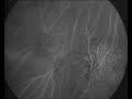 fluorescent particles added to red blood cells which make them glow when exposed to infrared light. this allows imaging of the movement of individual blood cells through capillaries at the back of the eye in rabbits. read more at http://technology.newscientist.com/channel/tech/mg20026765.800-nanomagnets-inside-blood-cells-bring-scans-into-focus.html