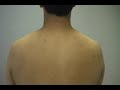 The Acne Practice  (Back Acne 2)