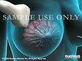 3D Medical Animation: Breast Tissue Biopsy