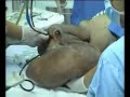 elephant man elephant man