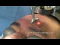 Profractional Acne Scar Removal Profractional Acne Scar Removal