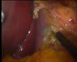 Bendaggio Gastrico Laparoscopico - N. Perrotta