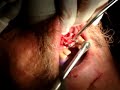 Implant and bone graft with collagen membrane #1
