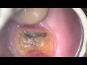 severe decay removed on root and tooth is saved from extraction