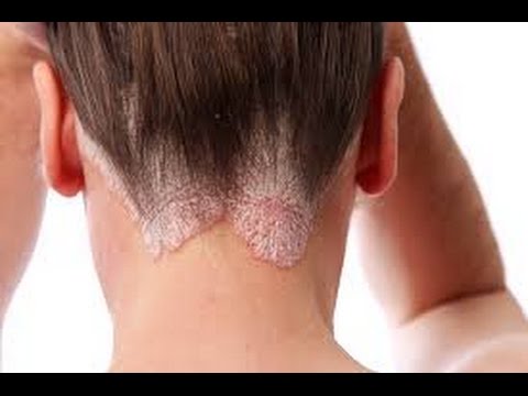 how to relieve psoriasis itching