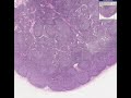 Histopathology Lymph node -- Follicular hyperplasia Histopathology Lymph node -- Follicular hyperplasia